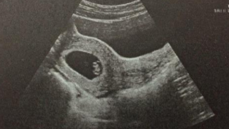 At 50, pursuing IVF proves that sometimes choosing wisely is more effective than simply trying hard.